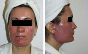 photo of typical post laser redness after laser resurfacing