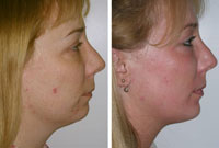 before and after laser treatment for acne scars, Richmond VA