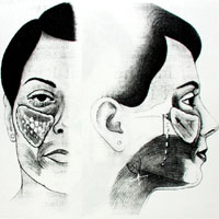 Illustration of youthful fat distribution in the cheek