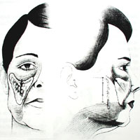 Illustration of aging fat distribution in the cheek