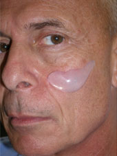 Submalar Implant, Cheek Implant, Richmond VA