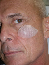 Malar Shell Implant, Cheek Implant, Richmond VA