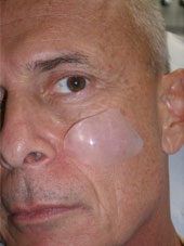 Combined Submalar Implant, Cheek Implant, Richmond VA