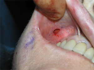 Photo of small incision for Cheek Implant