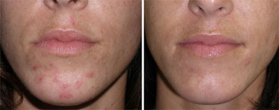 Before and after photos of acne treated with Omnilux.