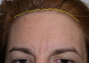Showing where the incision is made just behind the hairline for the mini open brow technique, the most stable type of brow lift with results that last longer