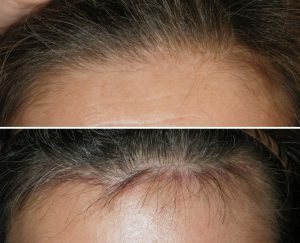 Before and After Mini-Open Brow Lift Patient's hairline before mini open brow lift and 8 weeks after surgery with new hair growth covering the scar