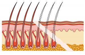 illustration of hair follicles growing through the precision incision of Brow Lift Surgery