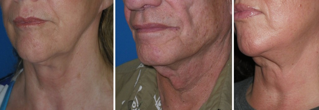 short cut 'facelift' frequently fails to produce natural and lasting results