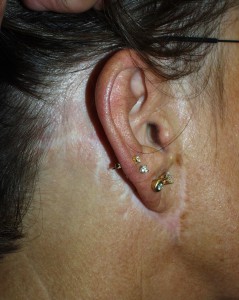 This patient was operated on by another surgeon and presented with several problems: The front incision is made in front of the ear instead of hiding it inside the ear and the back incision is too low and visible