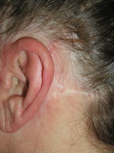 This scar (left) was placed too low where it is very noticeable