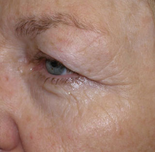 Upper Eyelid Surgery, eyelids droop, Richmond VA