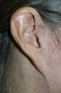 Pixie Ear Lobe example (NOT done by Dr Niamtu)