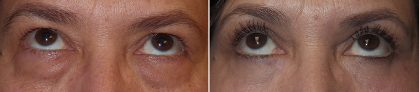 upper and lower eyelid surgery
