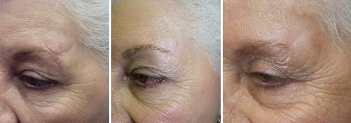 facial scars