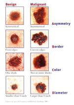 melanoma warning sighs