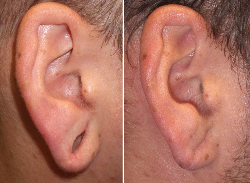 gauged earlobe repair- 17