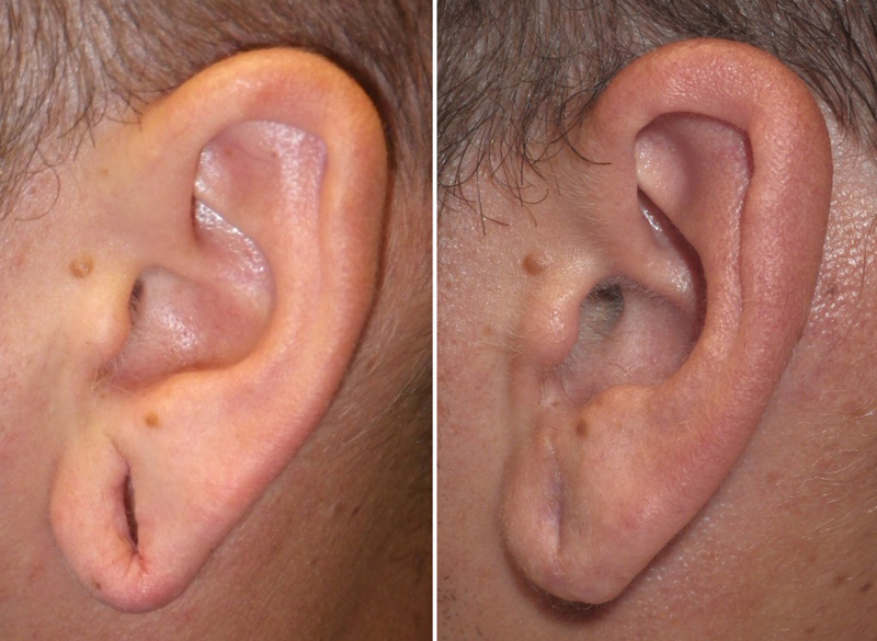 gauged earlobe repair