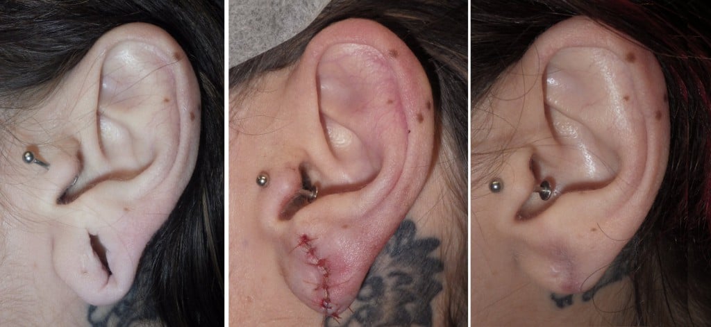 gauged earlobe repair in richmond