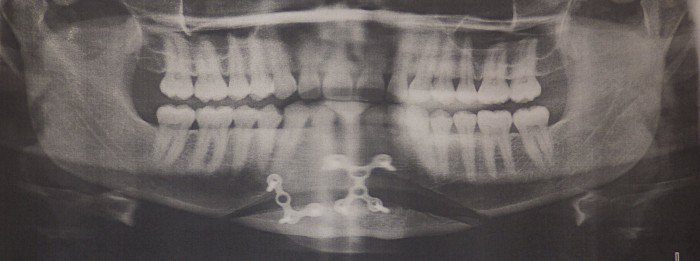 lengthening-genioplasty-case-1d