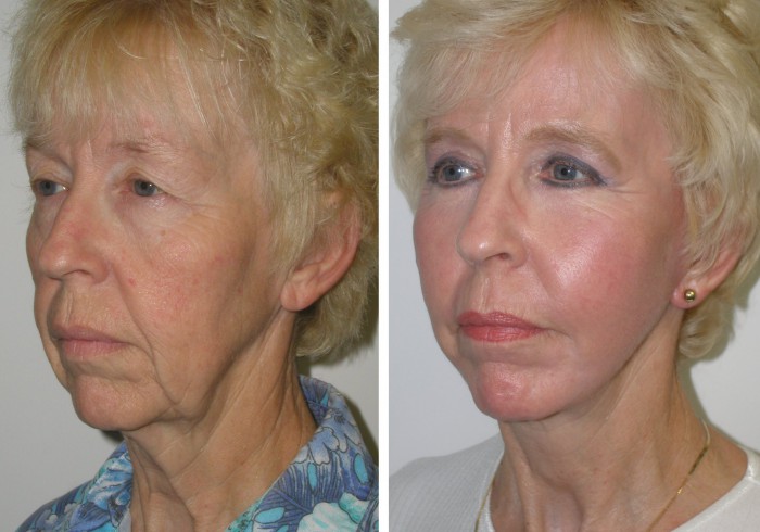Kybella figure 11