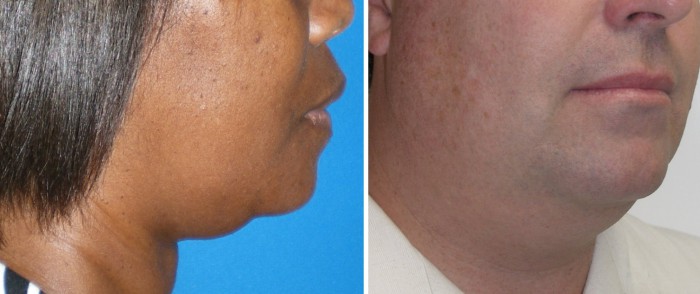 kybella figure 1