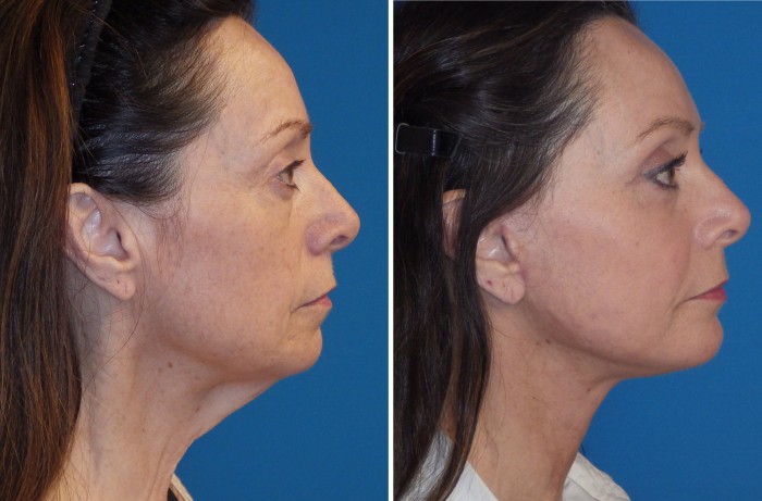 kybella figure 10
