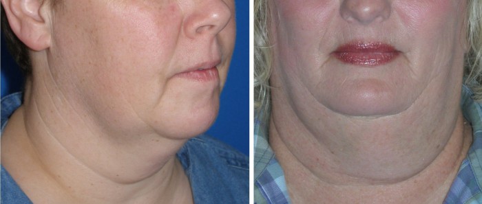 kybella figure 2