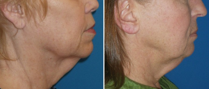 kybella figure 3
