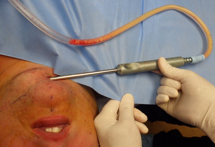 kybella figure 4