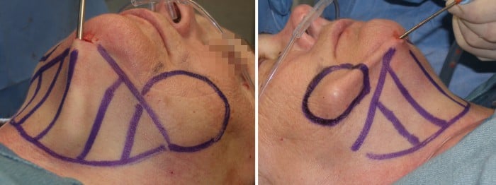 kybella figure 5
