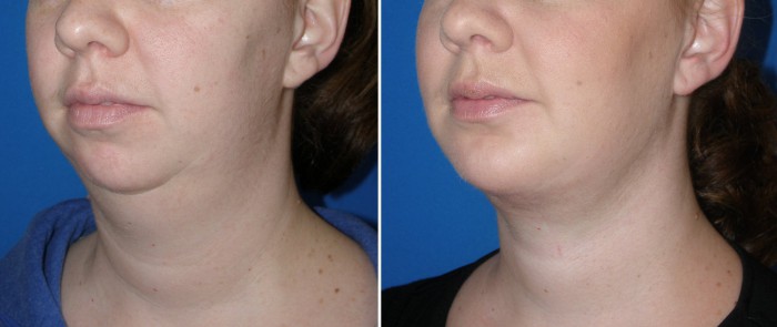 kybella figure 6