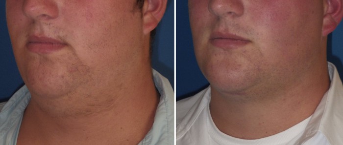 kybella figure 7