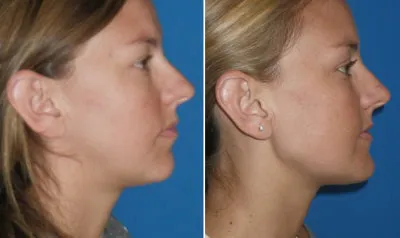 Chin & Lower Facial Implants in Richmond