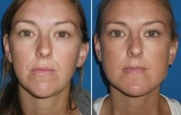 Chin & Lower Facial Implants in Richmond