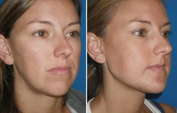 Chin & Lower Facial Implants in Richmond