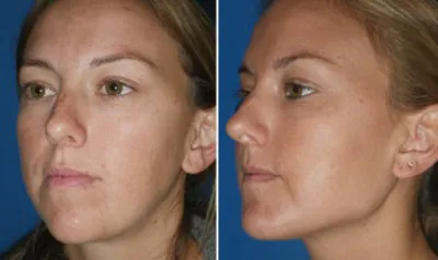 Chin & Lower Facial Implants in Richmond