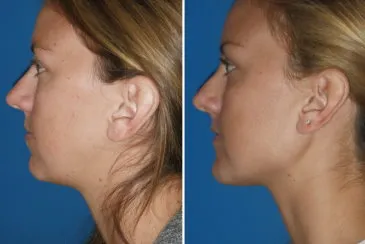 Chin & Lower Facial Implants in Richmond