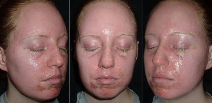 The face is very red for the first week after CO2 laser treatment, fading to pink the following week