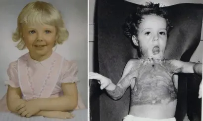 photos of 3-year-old before and after the 3rd-degree burns on torso and upper neck and face