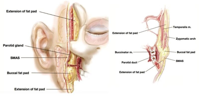 Buccal Fat Pad Reduction illustration