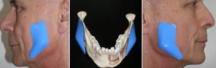 Chin & Lower Facial Implants in Richmond