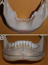 Chin & Lower Facial Implants