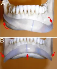 Chin & Lower Facial Implants