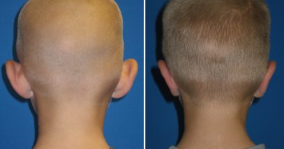 before and after otoplasty ear surgery