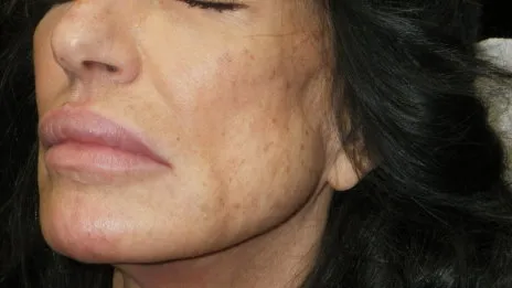 lower face fillers in richmond