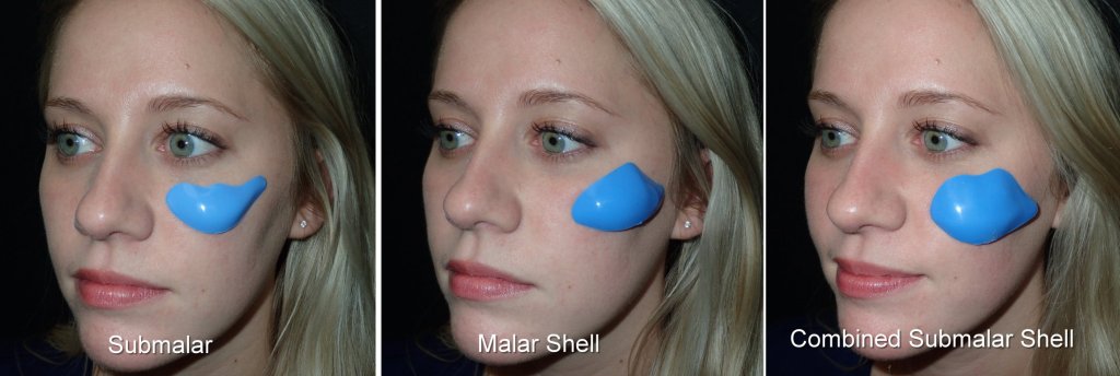 Submalar Implant, Malar Shell Implant and Combined Submalar Implant shown in blue