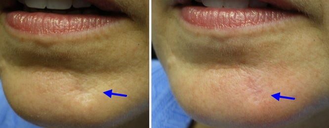 lower face fillers in richmond