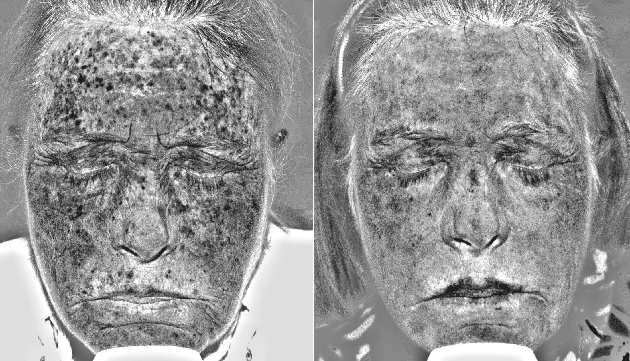 Scan on the right show the improvement of sun damage compared with the left