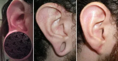 gauged earlobe repair